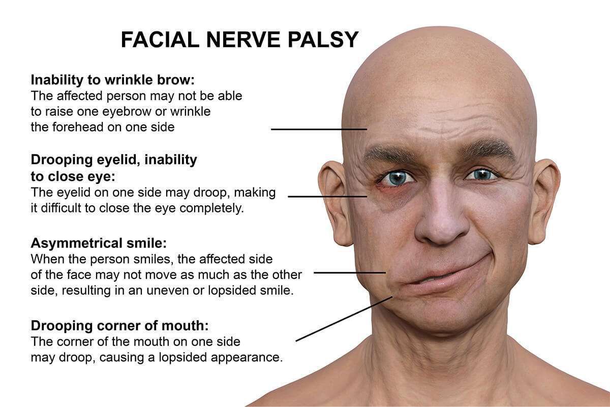 Symptoms of bell's palsy - MEDizzy