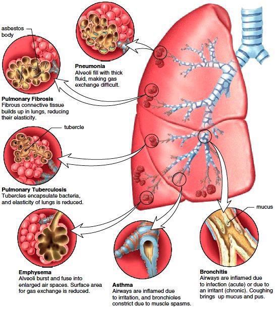 Pathology of the most common diseases of Respiratory system - MEDizzy