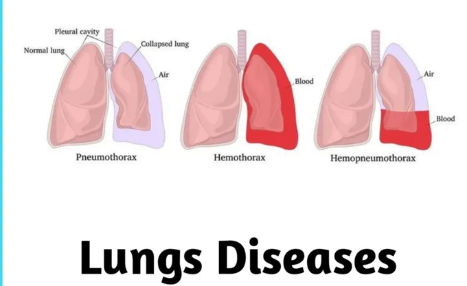 Lung Diseases - MEDizzy