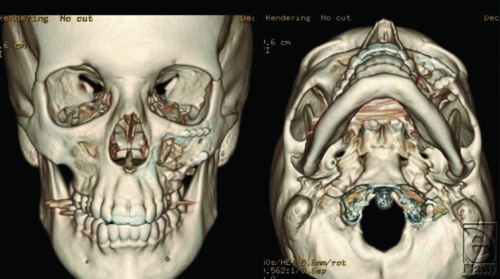 Zygomaticomaxillary Complex Fracture - PMC