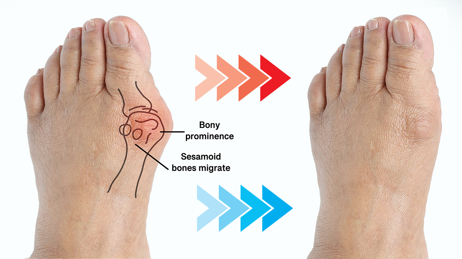 bunion treatment