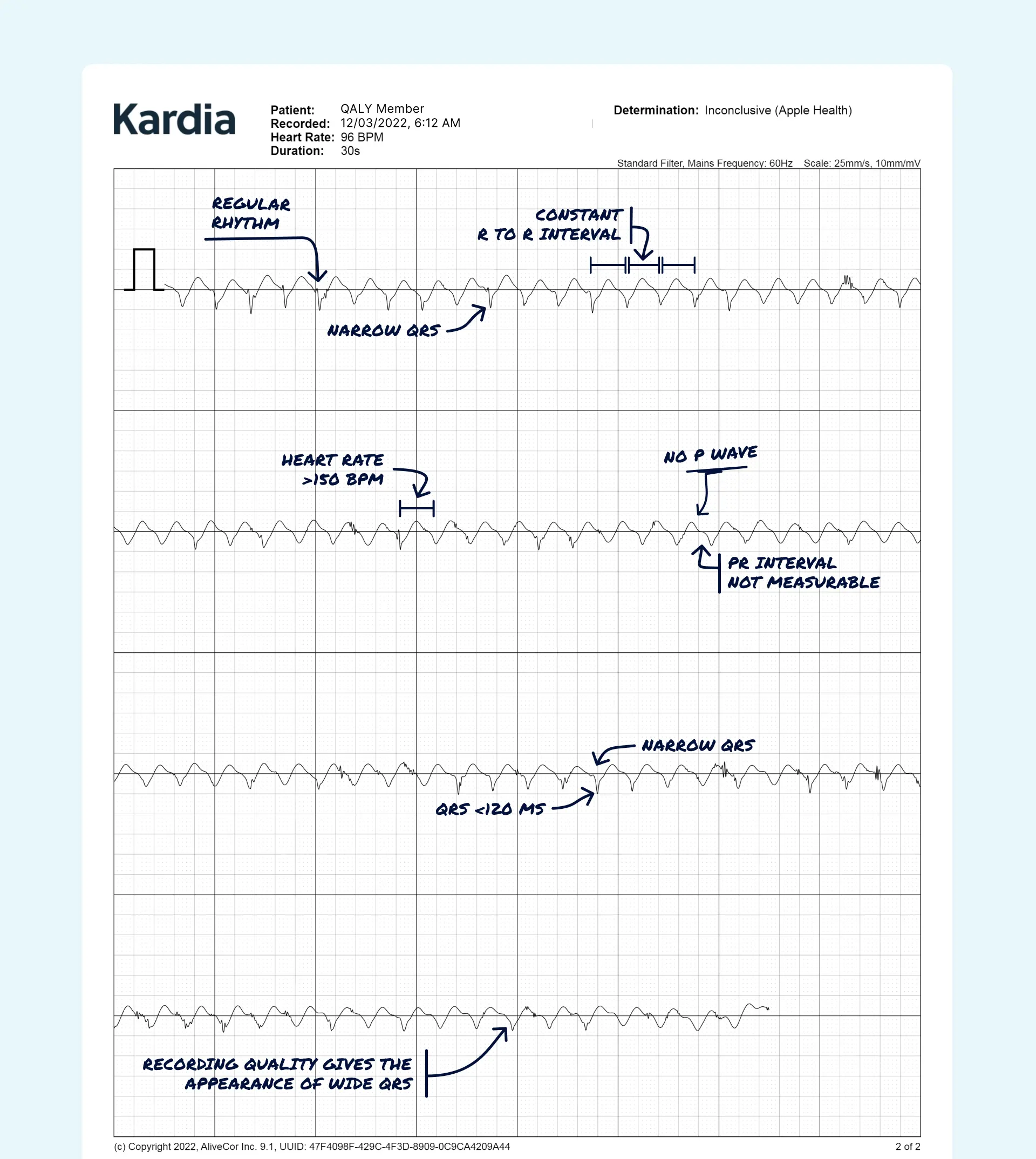 SVT read on an Apple Watch ECG through the Qaly app.