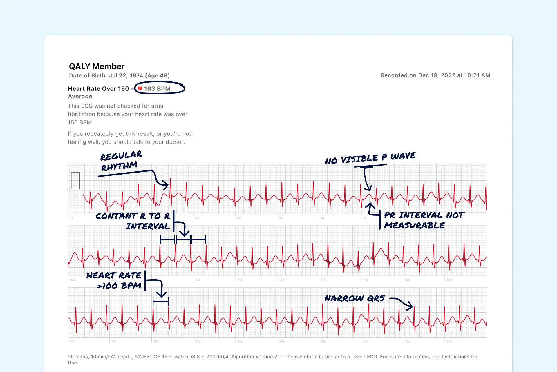 SVT read on an Apple Watch ECG through the Qaly app.