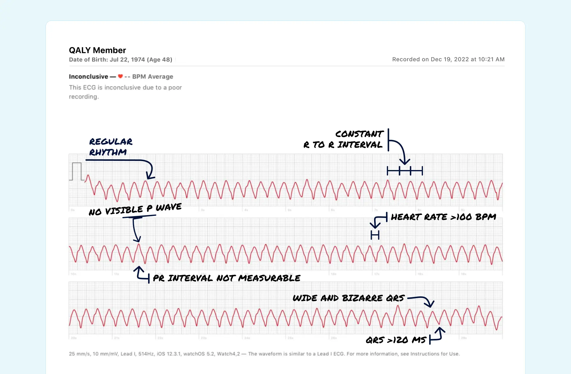 VTach read on an Apple Watch ECG through the Qaly app.