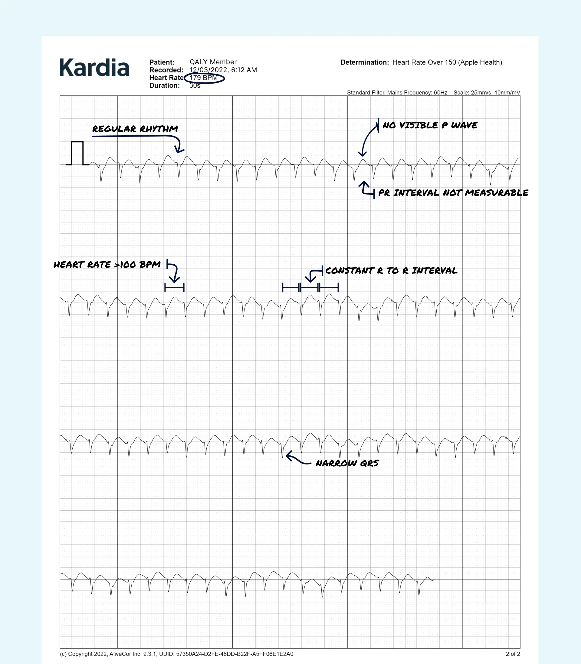 SVT read on a Kardia ECG through the Qaly app.