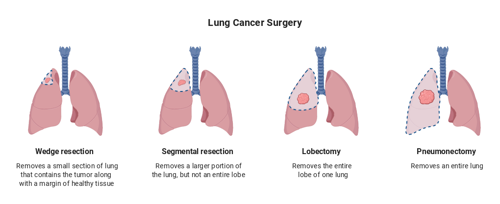 Lung Cancer Surgery with Description (Horizontal) | BioRender Science ...