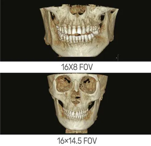 Tomógrafo dental cone beam con FOV de hasta 16X14.5