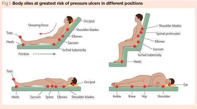 [DIAGRAM] Pressure Ulcer Pressure Points Diagrams - MYDIAGRAM.ONLINE