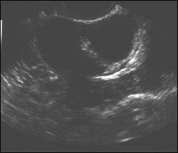 Some ovarian tumors can be safely followed on ultrasound