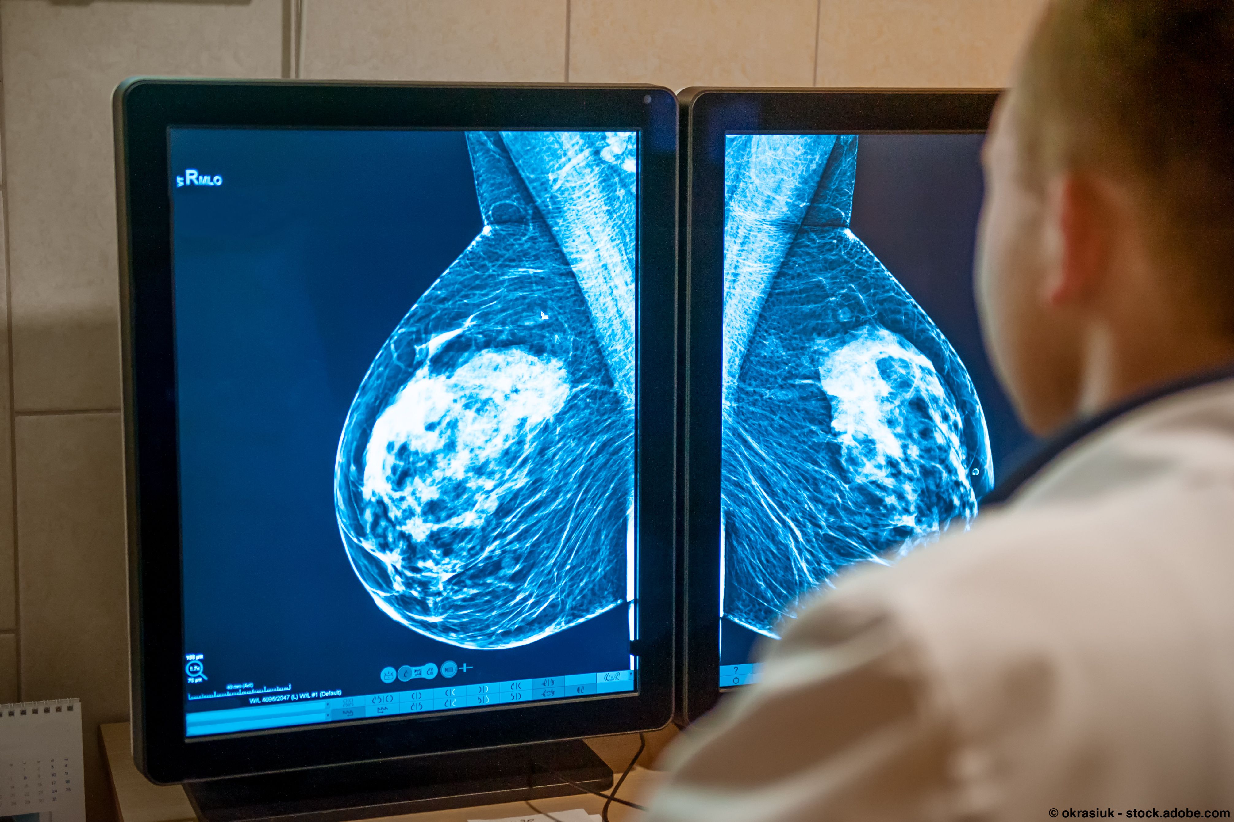 An image of a doctor looking at a breast cancer scan.