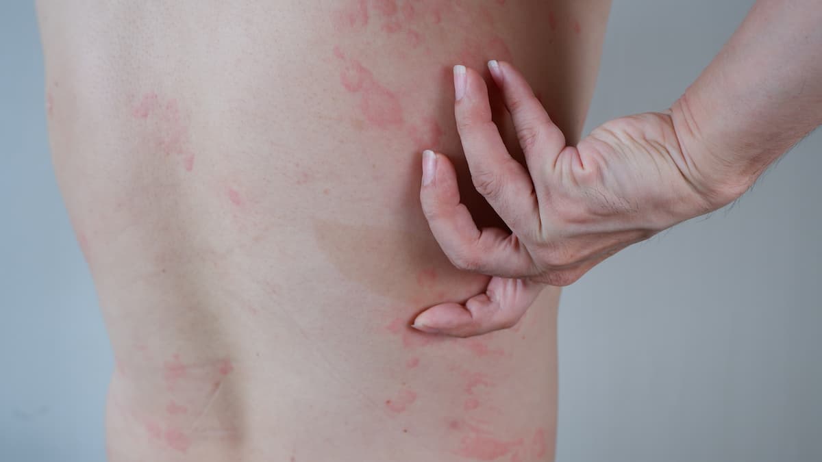 Close up image of skin texture suffering severe urticaria or hives or kaligata on back.