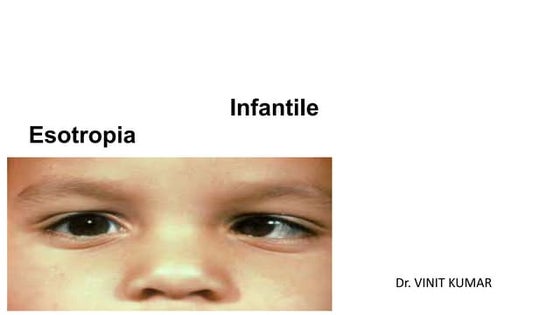 Essential infantile esotropia BY DR. VINIT KUMAR. Fellow Pediatric Ophthalmol...