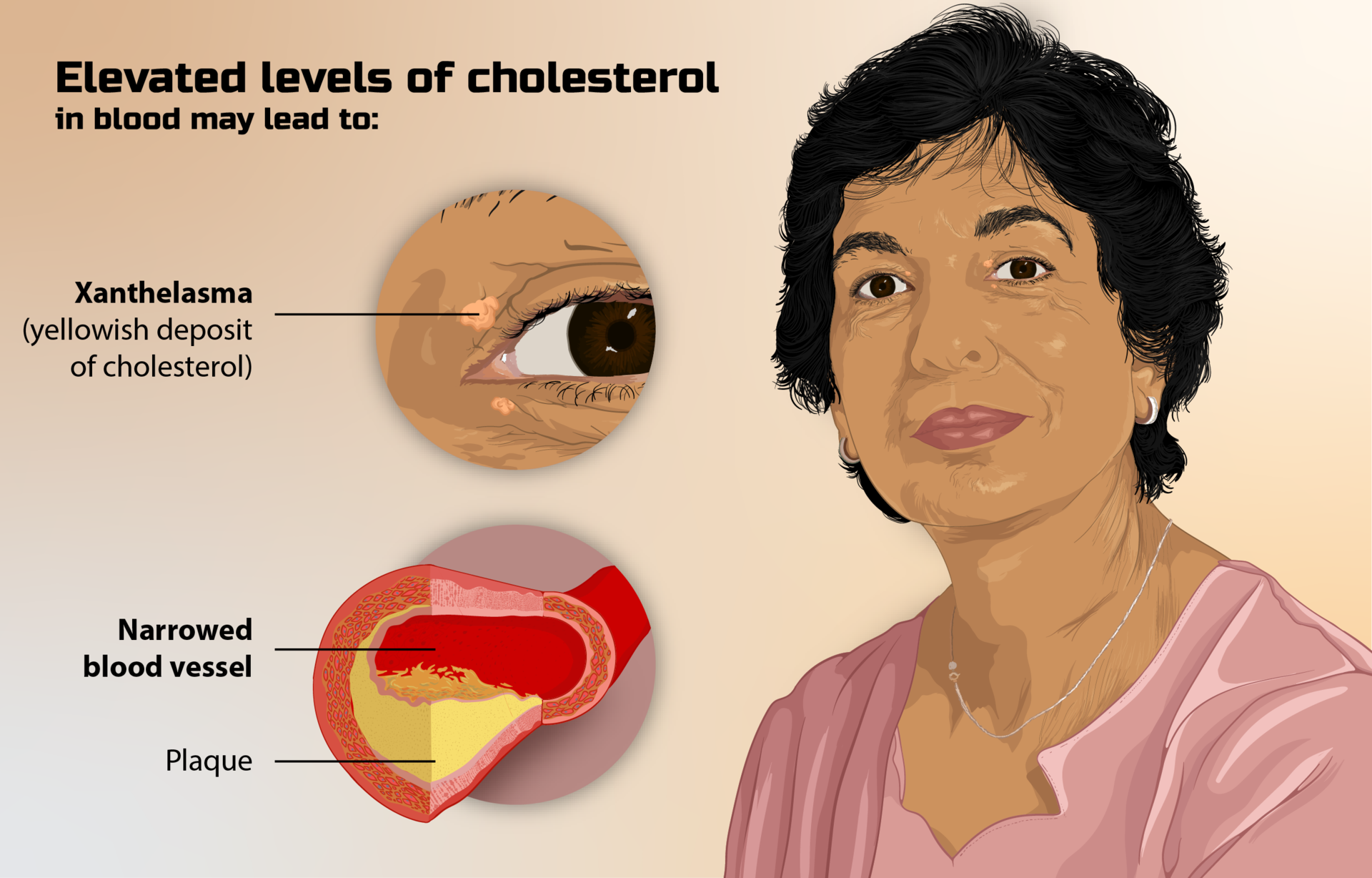 High Cholesterol Symptoms