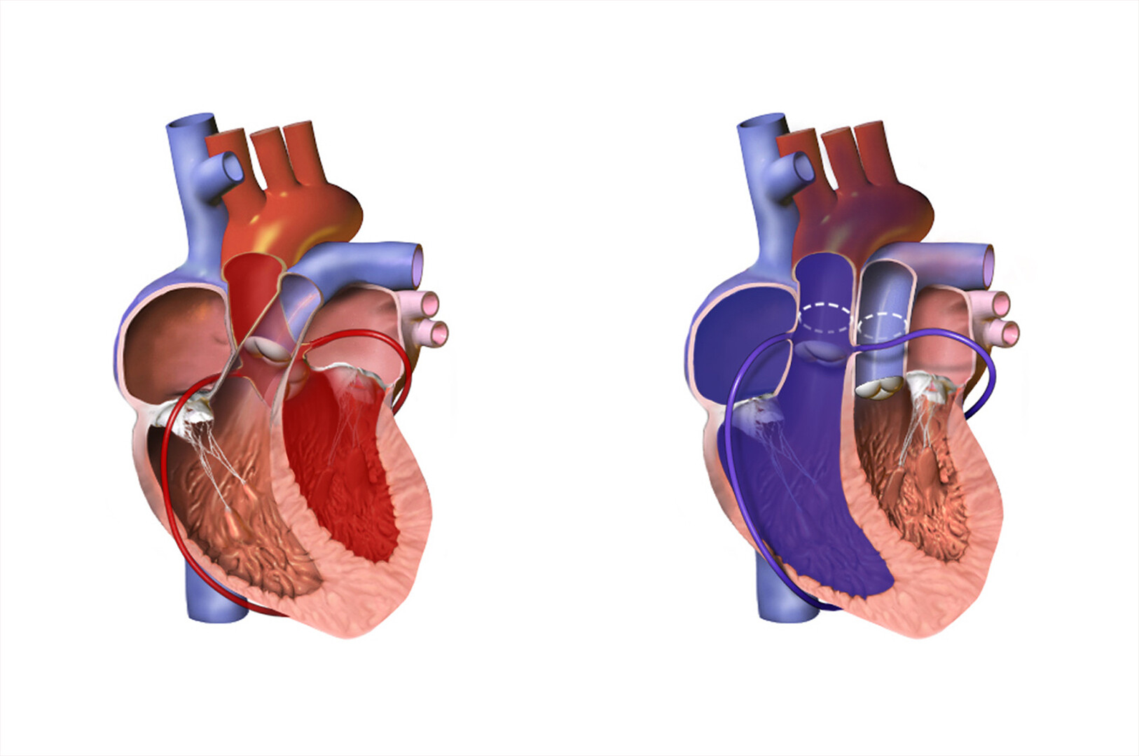 Transposition Of The Great Arteries Coronary Artery Anatomy