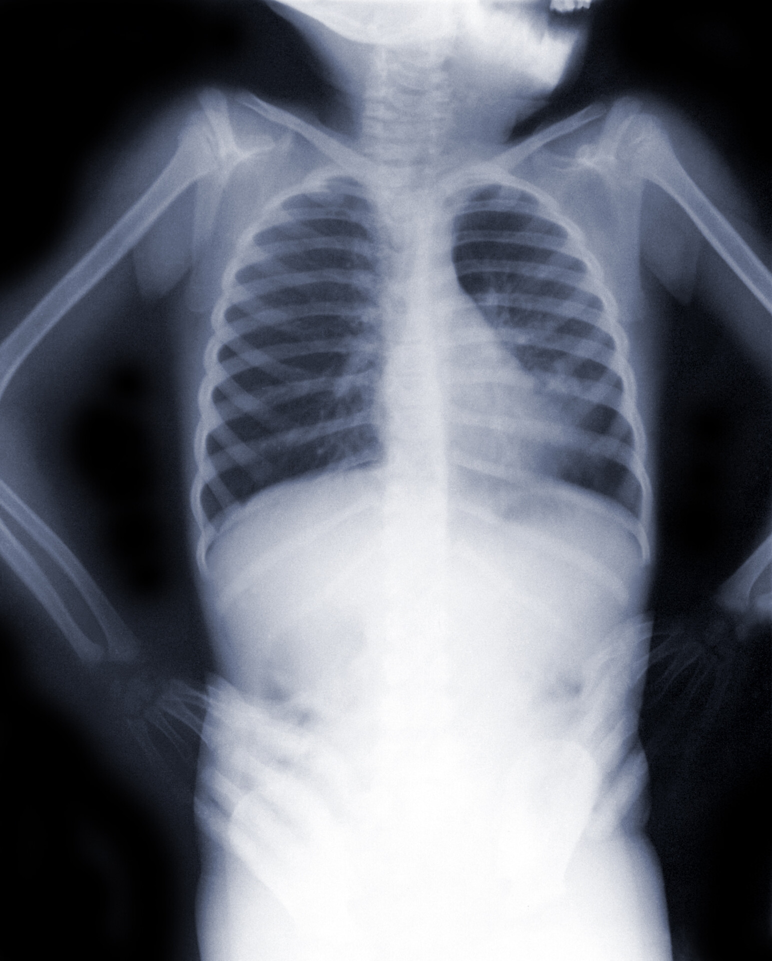 Atypical Pneumonia X Ray