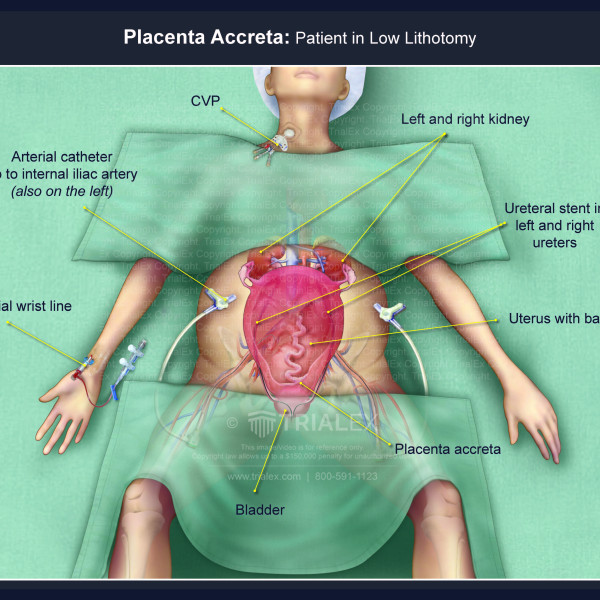 Placenta Accreta: Patient in Low Lithotomy