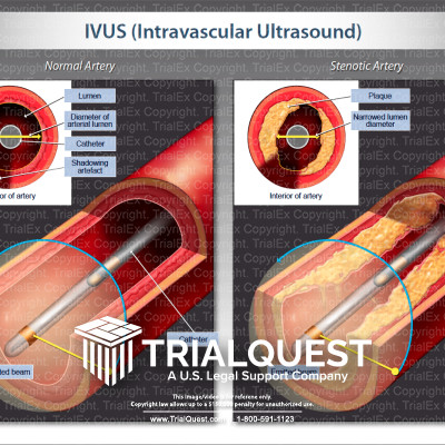 IVUS (Intravascular Ultrasound)