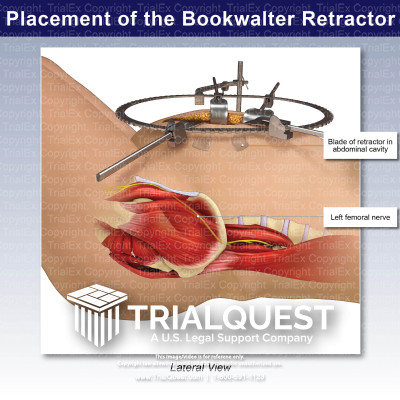 Placement of the Bookwalter Retractor