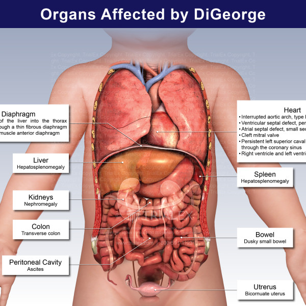 Organs Affected by DiGeorge