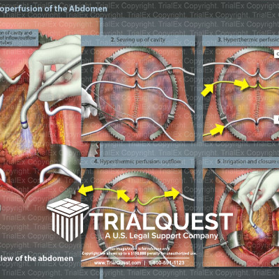 Hot Chemoperfusion of the Abdomen