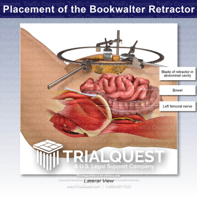 Placement of the Bookwalter Retractor Illustration