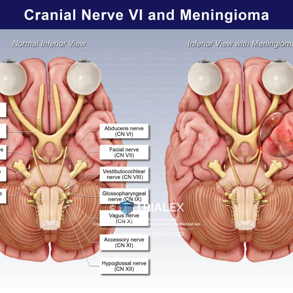 Cranial Nerve VI and Meningioma