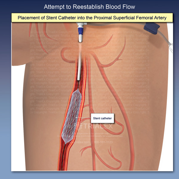 Placement of Stent Catheter into the Proximal Superficial Femoral Artery