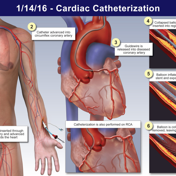 Cardiac Catheterization