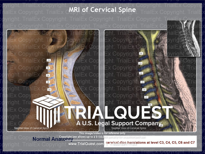 MRI of Cervical Spine