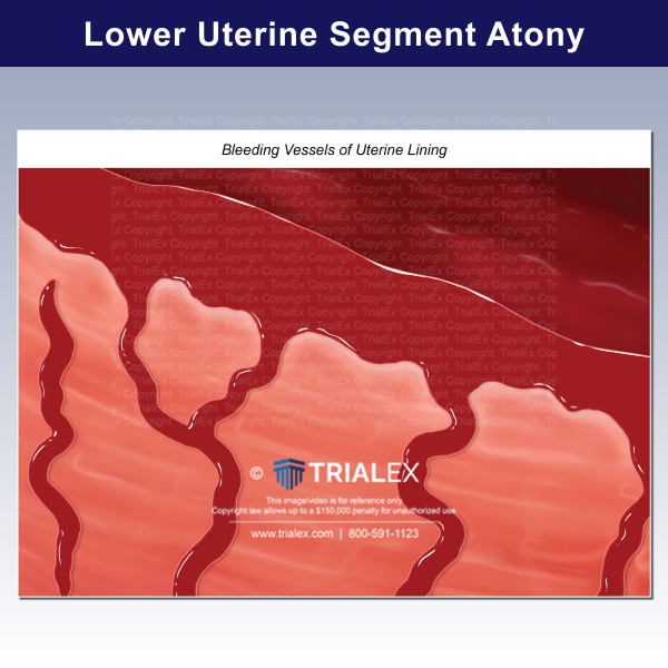 Lower Uterine Segment Atony