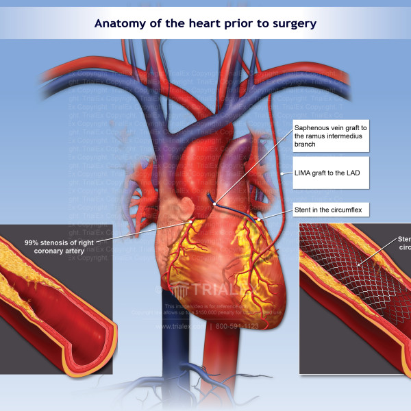 Anatomy of the heart prior to coronary bypass surgery