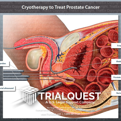 Cryotherapy to Treat Prostate Cancer