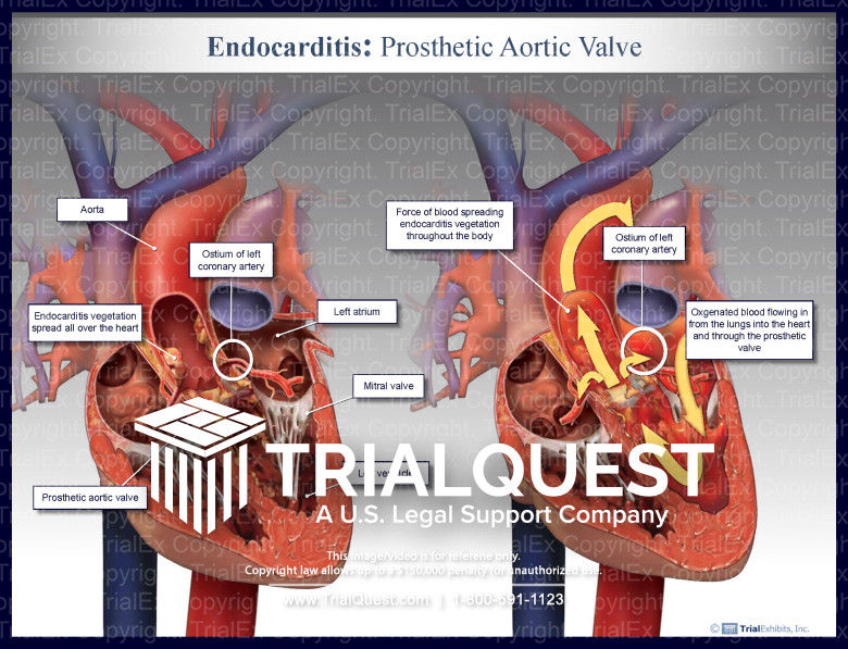 Endocarditis Vegetation