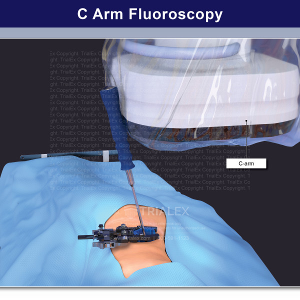 C Arm Fluoroscopy for XLIF Surgery