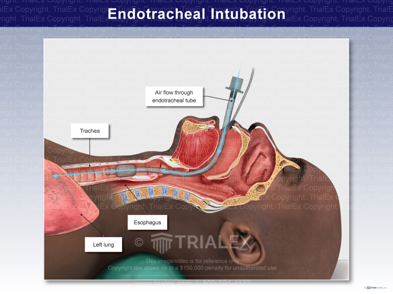 Endotracheal Intubation Tube Inserted In Airway 1