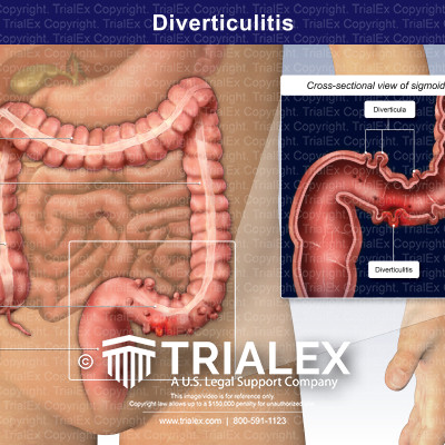 Diverticulitis