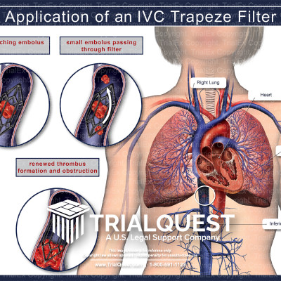 Application of an IVC Trapeze Filter