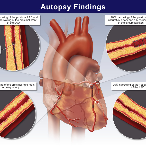 Autopsy Findings