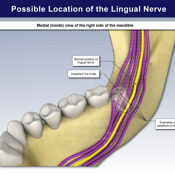 Possible Location of the Lingual Nerve