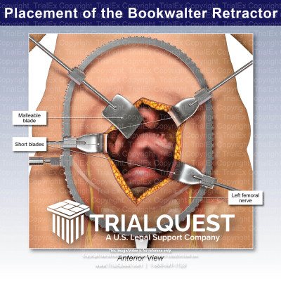 Placement of the Bookwalter Retractor