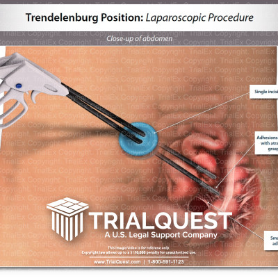 Trendelenburg Position: Mid-Laparoscopic Procedure