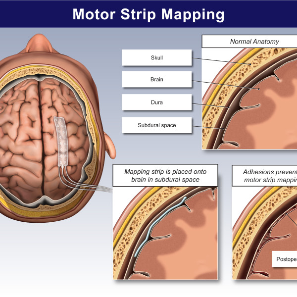 Motor Strip Mapping