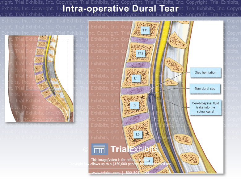 Intra-operative Dural Tear