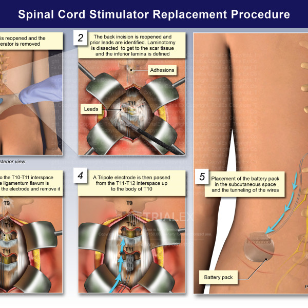 Spinal Cord Stimulator Replacement Procedure