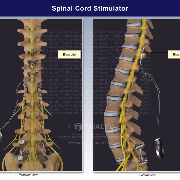 Spinal Cord Stimulator