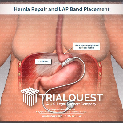 Hernia Repair and LAP Band Placement