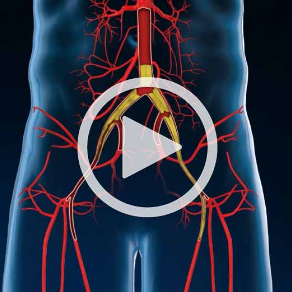 Revascularization