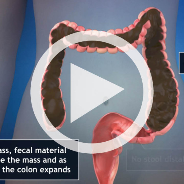 Alternative Scenario Following Timely Diagnosis of Sigmoid Colon Mass