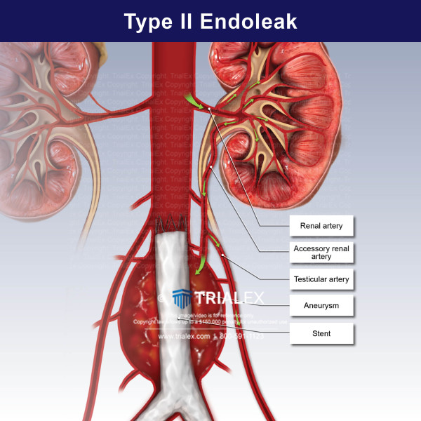 Type 2 Endoleak