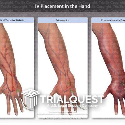 IV Placement in the Hand